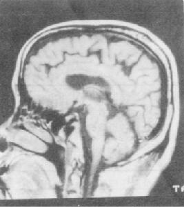健忘 健忘