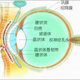 近視眼併發症