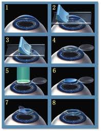 準分子近視手術 準分子近視手術