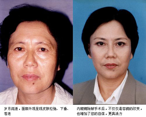 除皺前後對比圖 除皺前後對比圖