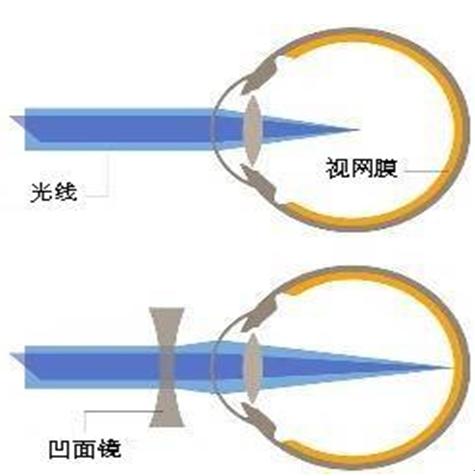 近視 近視