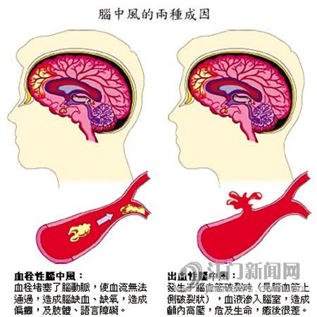 腦中風的成因 腦中風的成因